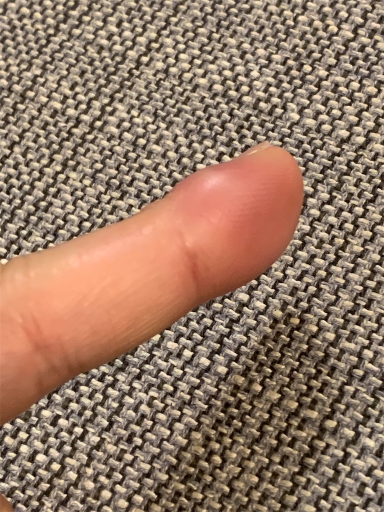 魚のヒレによる蜂窩織炎で腫れあがった中指